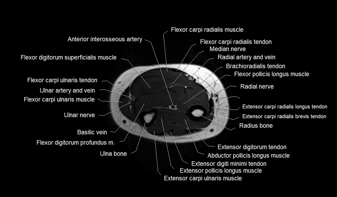 MRI 3T forearm axial cross sectional anatomy image 34.webp